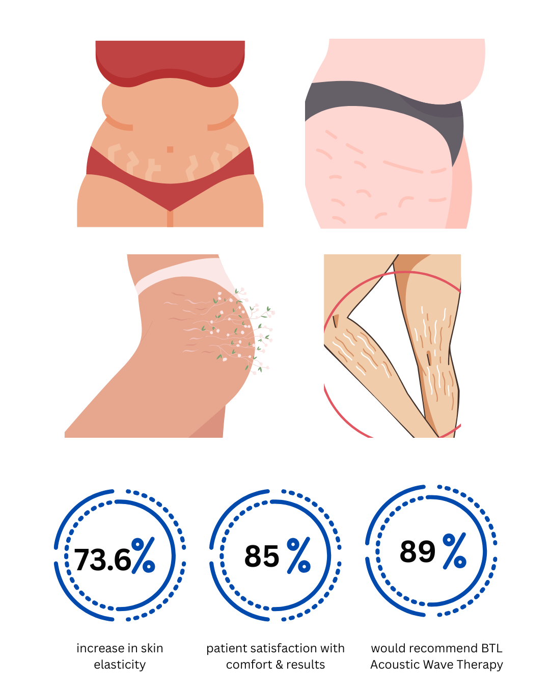 Benefits of BTL X-Wave | Treatment Areas | Clinical studies